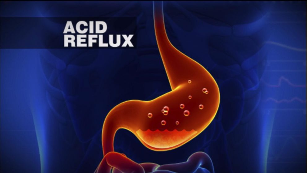 acid reflux