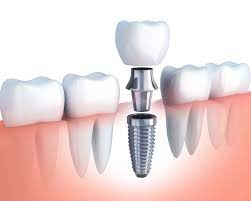 Dental Implant Clinic in Dubai