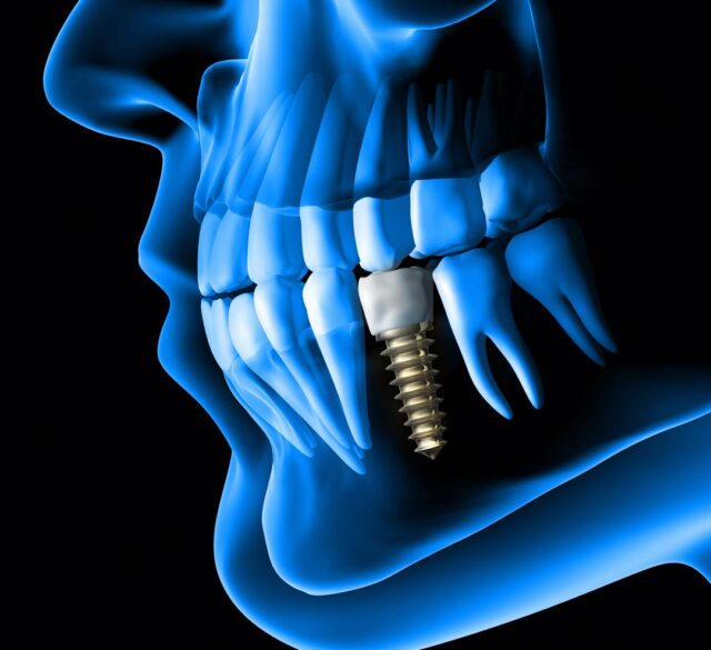 Best Dental Implant Clinic in Dubai