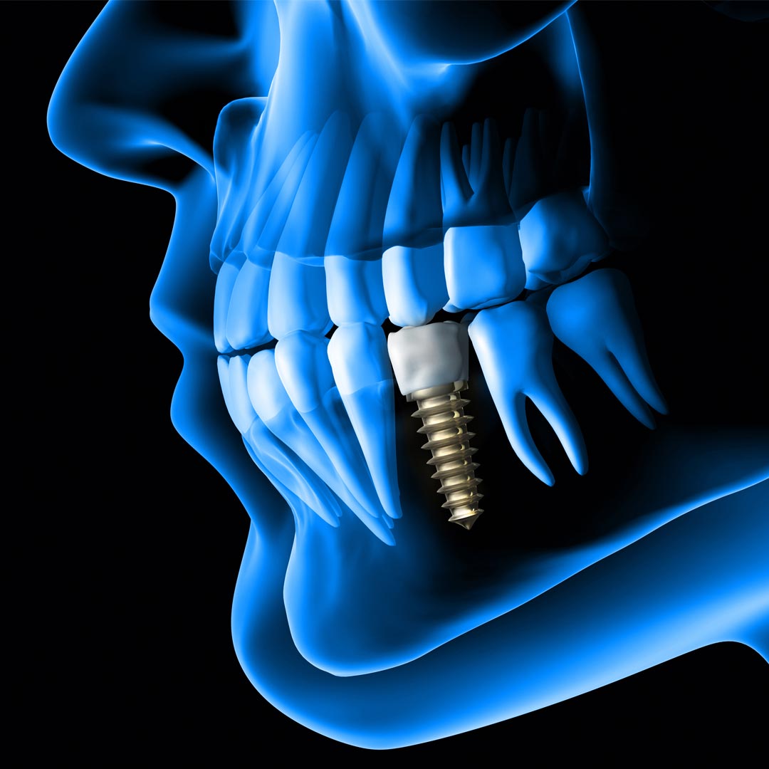 Best Dental Implant Clinic in Dubai